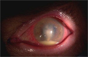 GOA - contact lens infectious keratitis